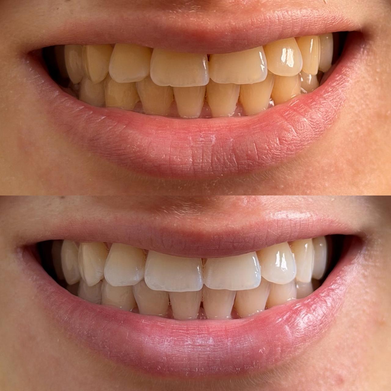 Comparação clínica de clareamento dental, na montagem original fornecida