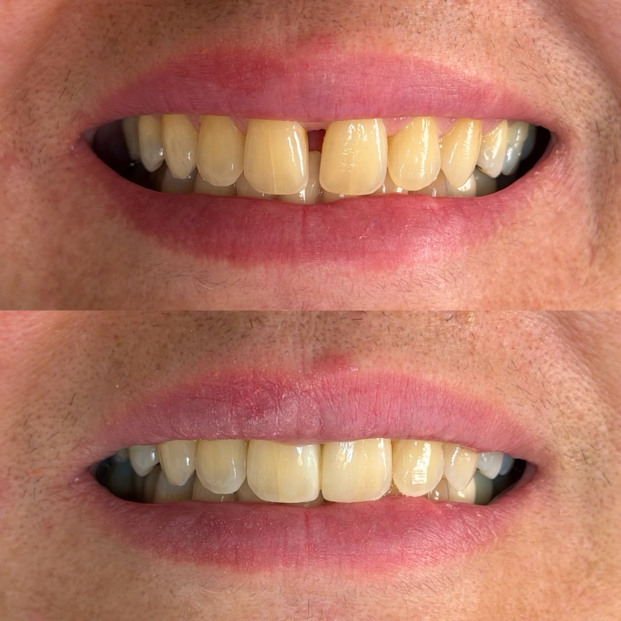 Comparação clínica de fechamento de diastema, na montagem original fornecida